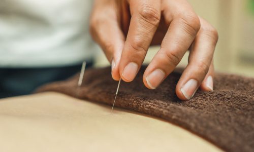 Alternative Medicine which is acupuncture in Asia Acupuncture needles for woman's body