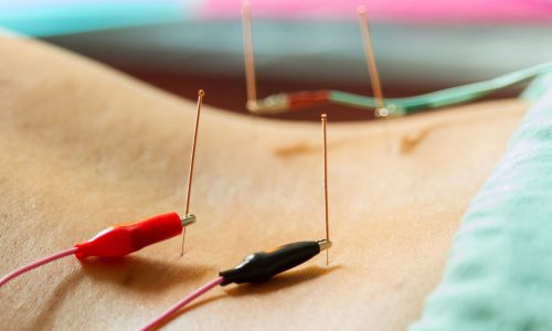 electro acupuncture