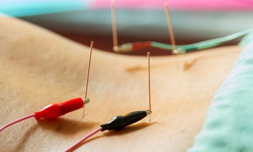 Acupuncture electro acupuncture