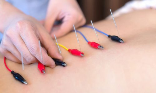 young woman undergoing acupuncture treatment at the health spa.