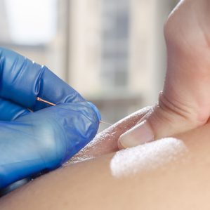 Closeup of a needle and hands of physiotherapist doing a dry needling.