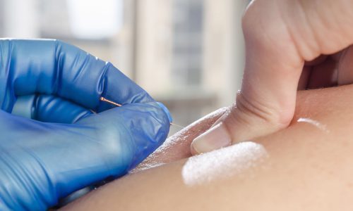 dry needling/trigger point acupuncture dry needling/trigger point acupuncture